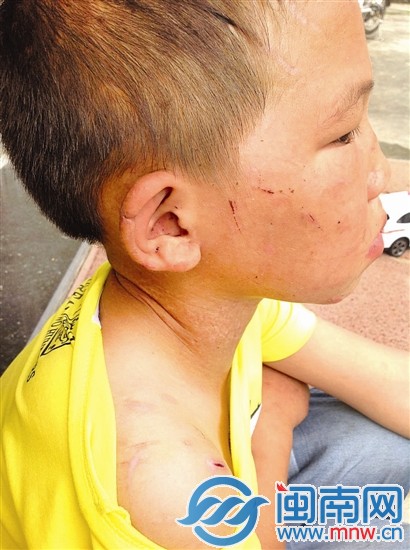 男孩的耳朵、脖子、脸上，有很多明显的伤痕