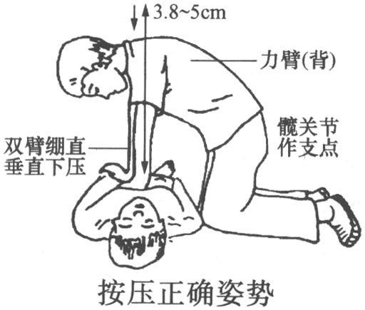 心肺复苏急救步骤图例