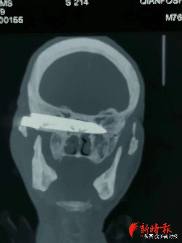 一把刀在藏族老人头内“扎”了26年，山东医生为其精准取刀